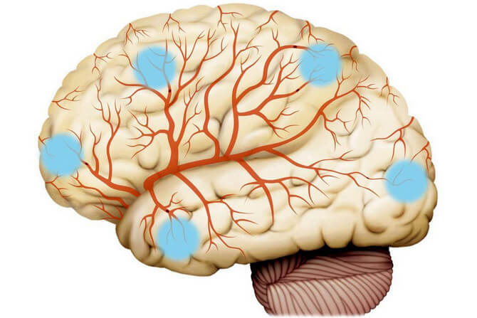 Мозг под ударом: как помешать нейроинфекциям навредить 